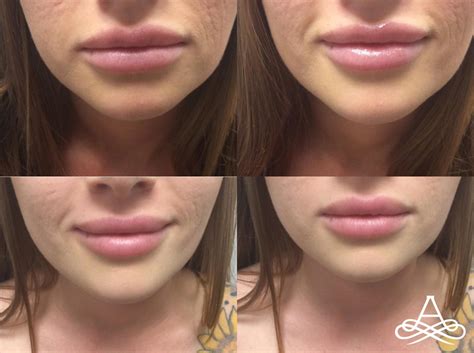 Lip Filler Before And After Instructions at Sergio Hasting blog
