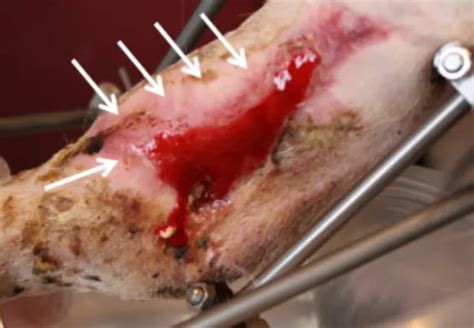 managing degloving shearing injuries step  step guide