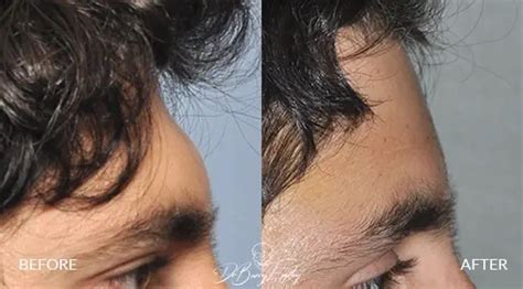 Aesthetic Forehead Surgery | Dr. Barry L. Eppley