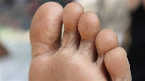 Foot Fungus: Causes, Symptoms and Treatment | 2024