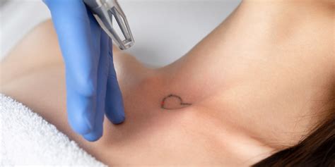 Pico Laser Tattoo Removal | Cosmetics & Wellness Clinic | Mae Cosmetics ...