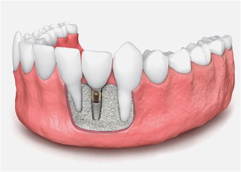 Bone Grafts to Support Your Dental Implants - Your Dental Health Resource