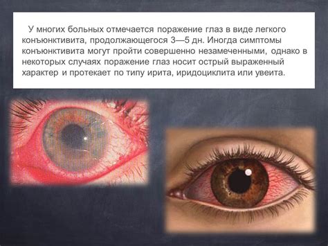 Презентация - Болезнь Рейтера » Привет Студент!