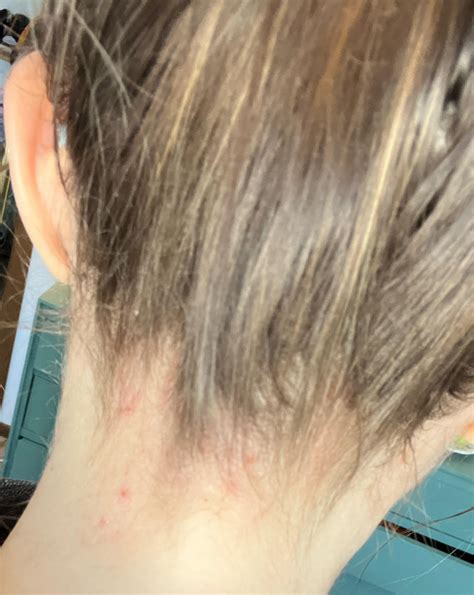 Itchy rash on back of neck/hairline for 2+ years, tried eccema cream