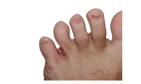 Understanding and Treating Erythrasma Between the Toes at Acacia Foot ...