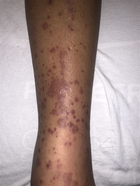 Purpura