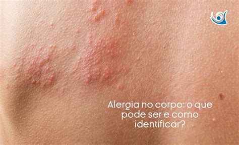 Alergia no corpo: o que pode ser e como identificar? - Alergoclínica