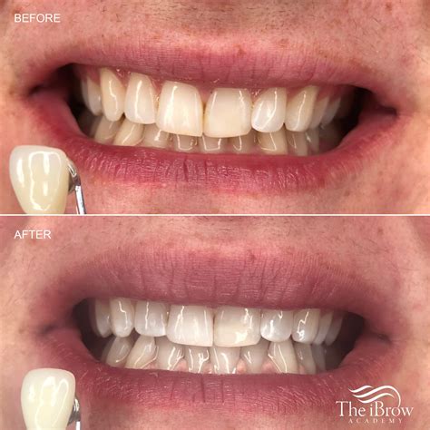 Teeth Whitening Course at Clarence Swingle blog