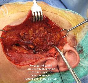 temporal arteritis giant cell arteritis  temporal artery biopsy