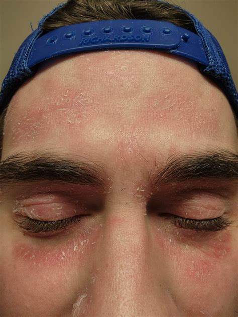 Does anyone's facial eczema look like this? : r/eczema