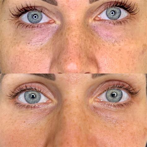 Polynucleotides — The Townhouse Clinic by Dr Lucy - Bath