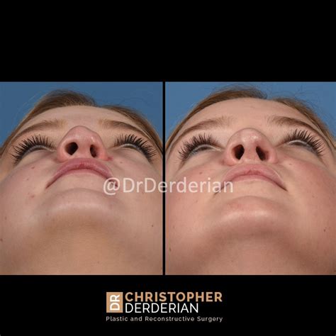 The Miracle Of Cleft Rhinoplasty How Surgery Can Restore A Lifetime Of Confidence