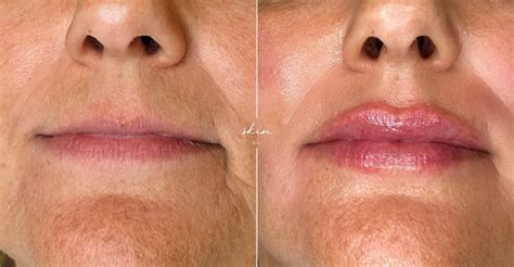 1 Ml De Ácido Hialurônico Na Boca Antes E Depois - Preenchimento labial: Casos de antes e depois do tratamento - Skin Boutique
