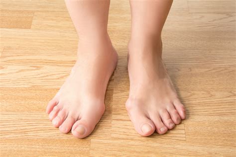 Bunion information and surgery options - The Horder Centre