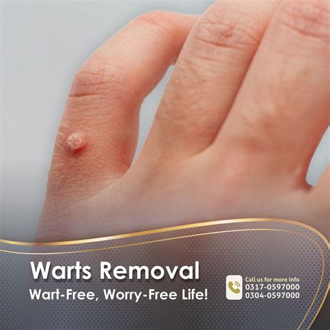 Klinic - Warts Removal Treatment Tired of stubborn warts? Our painless