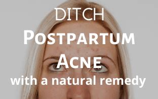 An All Natural Postpartum Acne Treatment - FitMommyStrong