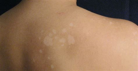 Doenças Causadas Por Fungos Sintomas Tratamento Prevenção