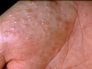 Pompholyx Eczema | National Eczema Society