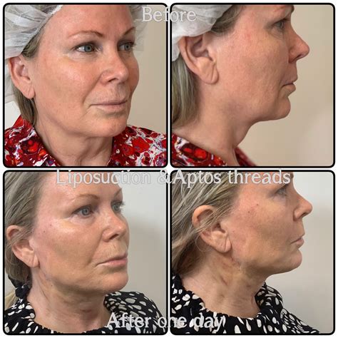 neck thread lifts neutral bay  tighten  smoothen  neck