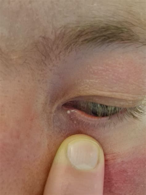 What is this white lump : r/medical_advice