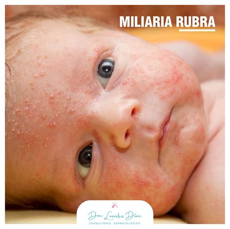 La miliaria rubra, también... - QARA - Dermatología Avanzada | Facebook