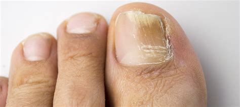 link  athletes foot  toenail fungus