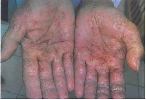 penyakit kulit  tangan perumperindocoid