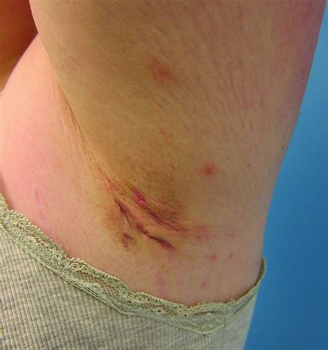 Hidradenitis supurativa - Trastornos dermatológicos - Manual Merck