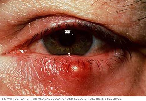 stye sty symptoms  mayo clinic