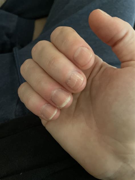 Whenever they get past my nail bed, I need to nibble them down. How do