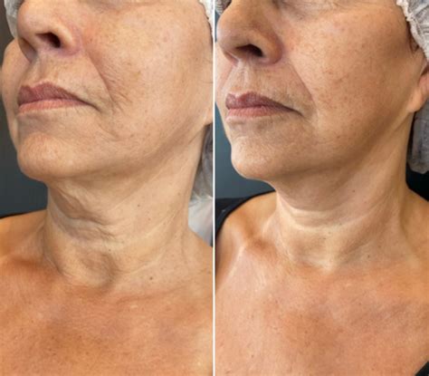 Ultraformer Antes E Depois Rosto - Ultraformer: Antes e depois – Antes da Fama
