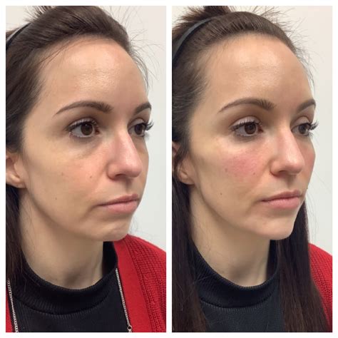 Jawline Chin Filler Results at Harvey Rosas blog