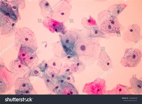 Abnormal Squamous Epithelial Cells View Microscopy Stock Photo ...
