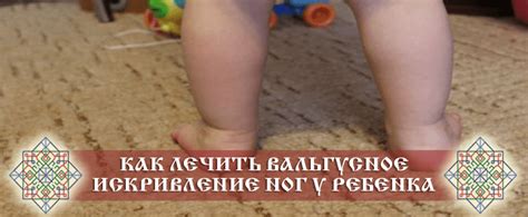 Вальгусное искривление у ребенка: причины и лечение