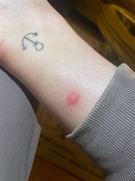 Mystery bump - Trying to identify this itchy/painful bump on my leg