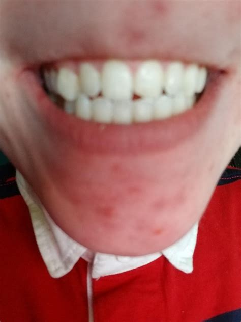 Class 1 malocclusion underbite fix mewing? : r/orthotropics