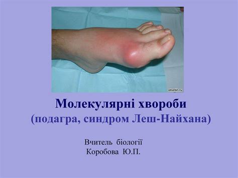 Презентація до уроку "Подагра"