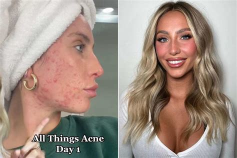 TikToks Alix Earle Opens Up About Her Long Struggle With Acne: I Did