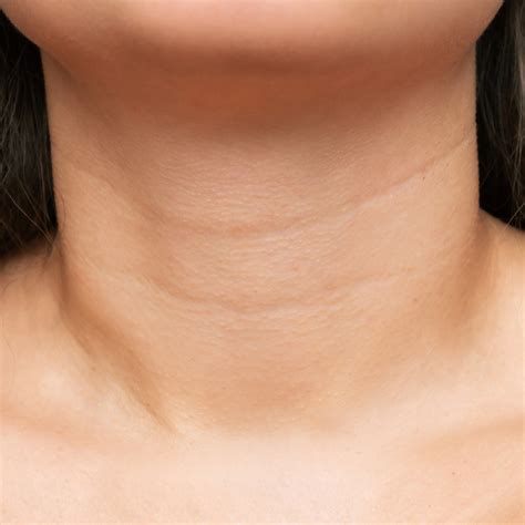 understanding neck wrinkles  treatment options