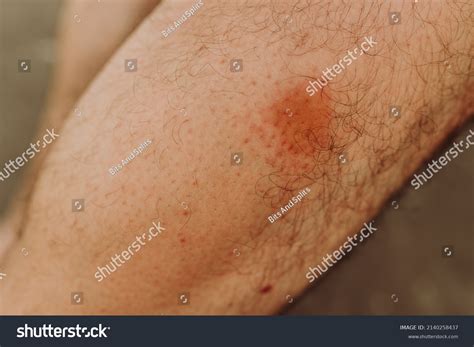 fly bites person goerseli stok fotograflar ve vektoerler