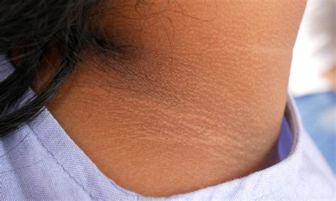 Acanthosis nigricans: what is it, symptoms, causes and treatment?