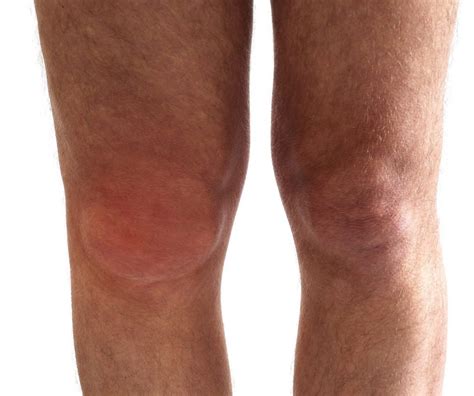 knees  swollen athleticfly