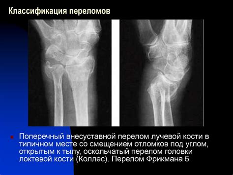 Рентгенодиагностика травмы запястья - online presentation