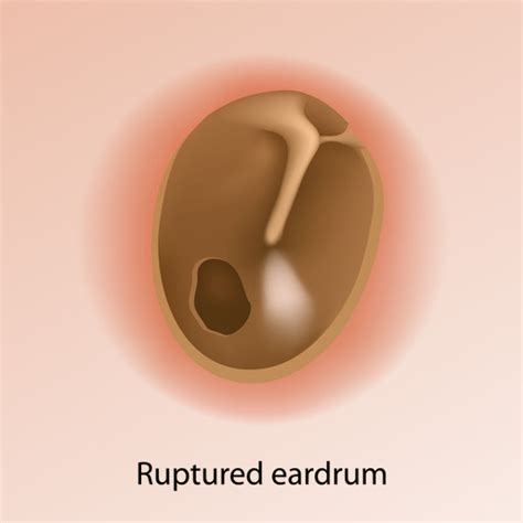 Tympanic Membrane Perforation