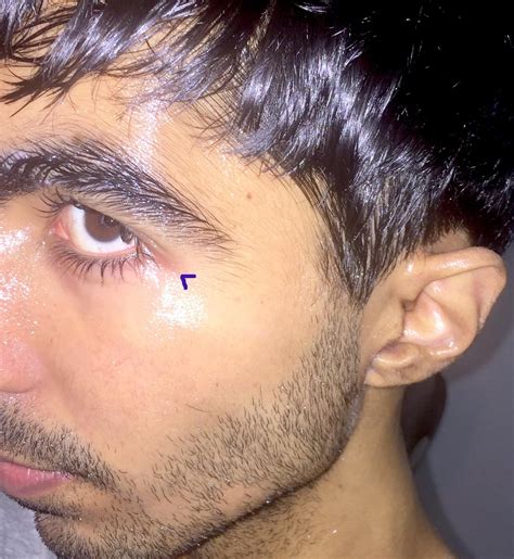 Does tretinoin have benefits under the eye : r/tretinoin