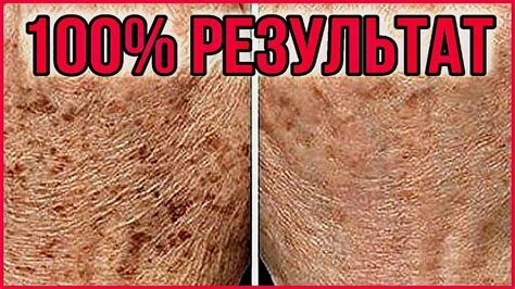 Эта СМЕСЬ «Стирает» пятна с кожи! БАБУШКИН рецепт от пигментных пятен ...