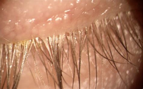Demodex Eyelash Mites