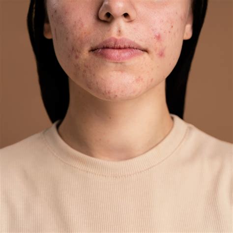 Scar Removal: Effective Treatments and Remedies - Hunter Games Magazine