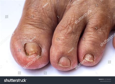 how to fix a crooked toenail