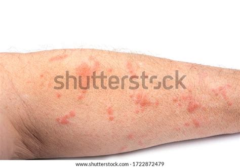 Skin Disease Rash On Mans Arm Stock Photo 1722872479 | Shutterstock